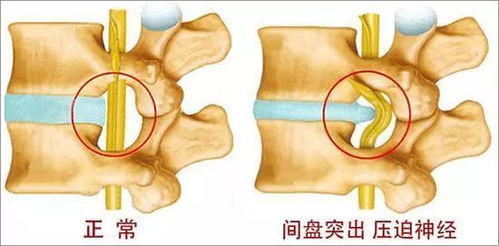 腰椎间盘突出压迫神经腿疼怎么治